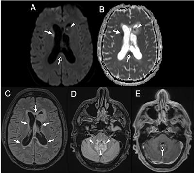 Case Report: Cerebral Nocardiosis Caused by Nocardia cyriacigeorgica Detected by Metagenomics in an Apparently Immunocompetent Patient